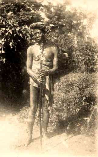 African Black Leper Real Photo